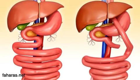 صورة بها شكلين للمعدة ضمن الحديث عن طرق إجراء عملية تحويل المسار
