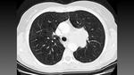 أشعة مقطعية للصدر Ct Chest؛ كيفية قراءة التقرير