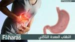 التهاب المعدة التآكلي Erosive Gastritis؛ وأهم