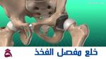 خلع مفصل الفخذ (Hip Dislocation): تعرف على أهم