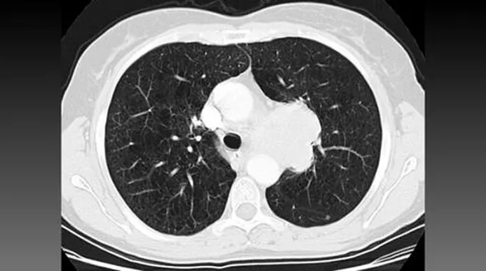 أشعة مقطعية للصدر Ct Chest؛ كيفية قراءة التقرير