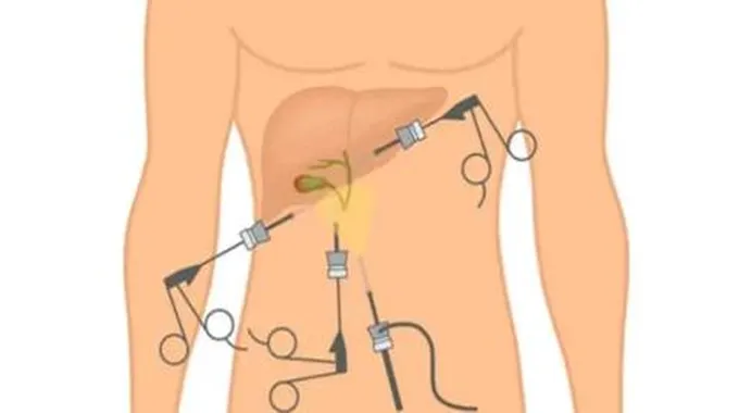 استئصال المرارة بالمنظار؛ تعرف على مدة هذه