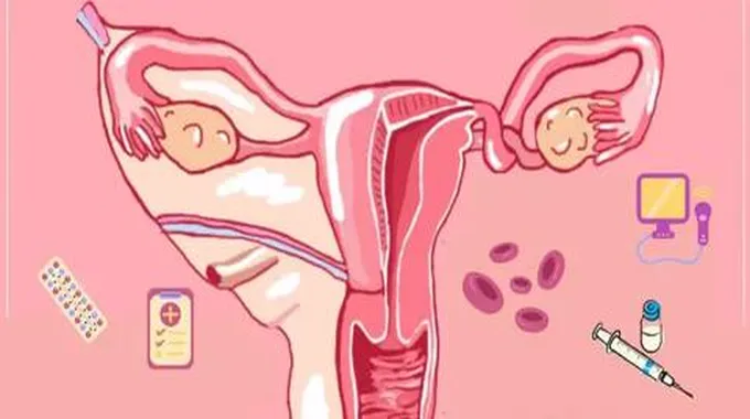 التواء المبيض (Ovarian Torsion)؛ ما هو وكيف