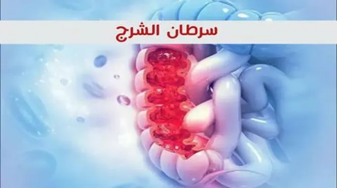 سرطان الشرج (Anal Cancer)؛ أسبابه وطرق العلاج