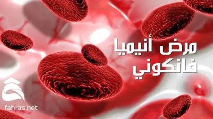 مرض أنيميا فانكوني (Fanconi Anemia)؛ تعرف على