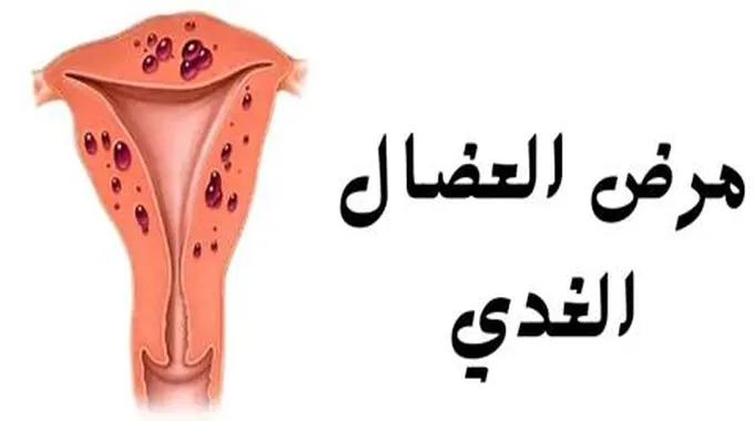 مرض العضال الغدي (Adenomyosis)؛ عوامل خطورة