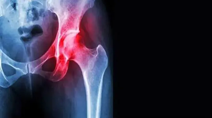 نخر العظام (Osteonecrosis)؛ أهم الأسباب وطرق